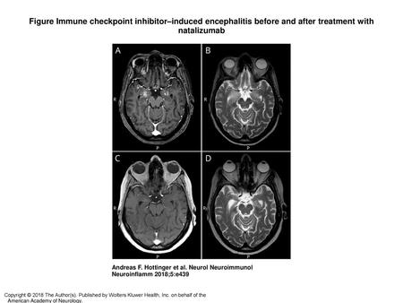 Figure Immune checkpoint inhibitor–induced encephalitis before and after treatment with natalizumab Immune checkpoint inhibitor–induced encephalitis before.