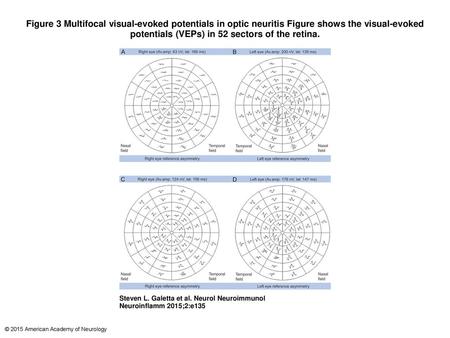 Figure 3 Multifocal visual-evoked potentials in optic neuritis Figure shows the visual-evoked potentials (VEPs) in 52 sectors of the retina. Multifocal.