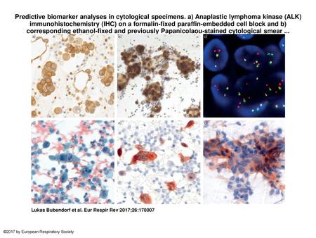 Predictive biomarker analyses in cytological specimens