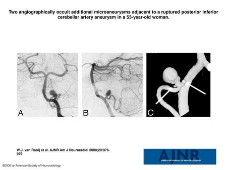 Two angiographically occult additional microaneurysms adjacent to a ruptured posterior inferior cerebellar artery aneurysm in a 53-year-old woman. Two.
