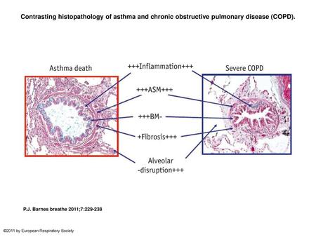 Contrasting histopathology of asthma and chronic obstructive pulmonary disease (COPD). Contrasting histopathology of asthma and chronic obstructive pulmonary.