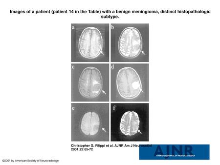 Images of a patient (patient 14 in the Table) with a benign meningioma, distinct histopathologic subtype. Images of a patient (patient 14 in the Table)