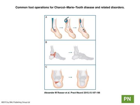 Common foot operations for Charcot–Marie–Tooth disease and related disorders. Common foot operations for Charcot–Marie–Tooth disease and related disorders.
