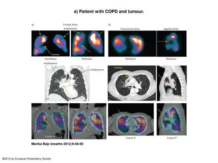 a) Patient with COPD and tumour.