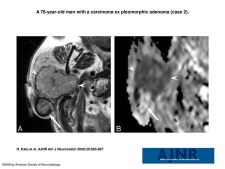 A 76-year-old man with a carcinoma ex pleomorphic adenoma (case 2).