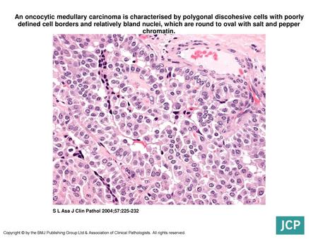 An oncocytic medullary carcinoma is characterised by polygonal discohesive cells with poorly defined cell borders and relatively bland nuclei, which are.