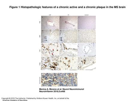 Figure 1 Histopathologic features of a chronic active and a chronic plaque in the MS brain Histopathologic features of a chronic active and a chronic plaque.
