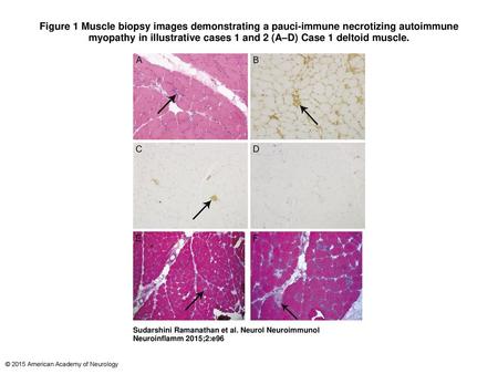 Figure 1 Muscle biopsy images demonstrating a pauci-immune necrotizing autoimmune myopathy in illustrative cases 1 and 2 (A–D) Case 1 deltoid muscle. Muscle.