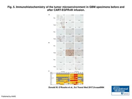 Fig. 5. Immunohistochemistry of the tumor microenvironment in GBM specimens before and after CART-EGFRvIII infusion. Immunohistochemistry of the tumor.