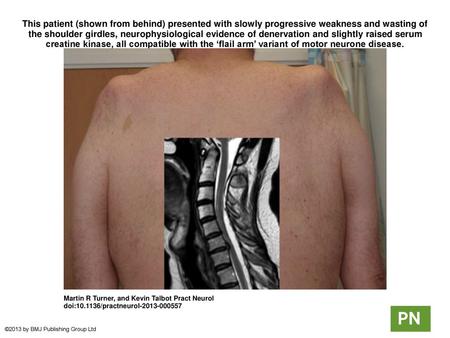 This patient (shown from behind) presented with slowly progressive weakness and wasting of the shoulder girdles, neurophysiological evidence of denervation.