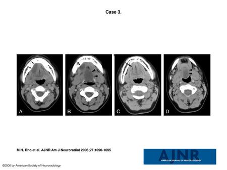 Case 3. Case 3. A 10-year-old boy with sublingual swelling shows partial shrinkage after 3 OK-432 injections.A and B, The initial contrast-enhanced CT.