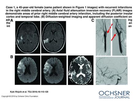 Case 1, a 45-year-old female (same patient shown in Figure 1 images) with recurrent infarctions in the right middle cerebral artery. (A) Axial fluid attenuation.