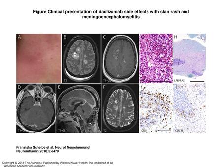Figure Clinical presentation of daclizumab side effects with skin rash and meningoencephalomyelitis Clinical presentation of daclizumab side effects with.
