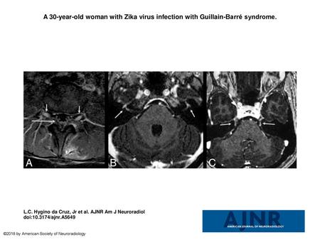 A 30-year-old woman with Zika virus infection with Guillain-Barré syndrome. A 30-year-old woman with Zika virus infection with Guillain-Barré syndrome.
