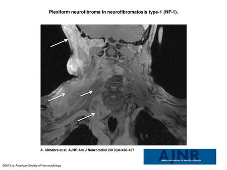 Plexiform neurofibroma in neurofibromatosis type-1 (NF-1).