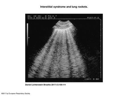 Interstitial syndrome and lung rockets.