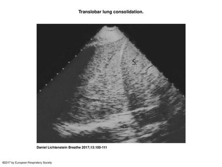 Translobar lung consolidation.