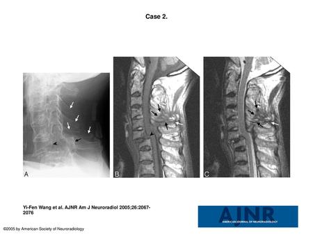 Case 2. Case 2. Fracture of the anterior C7 vertebral body and posterior C6 vertebral body with traumatic spondylolisthesis (C6 on C7), tearing of the.
