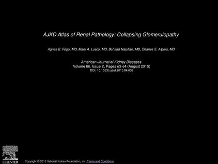 AJKD Atlas of Renal Pathology: Collapsing Glomerulopathy