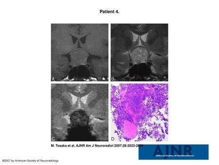 Patient 4. Patient 4. A 39-year-old woman had a solid nonfunctioning pituitary adenoma without cyst or hematoma. She had no past or present headache. A,