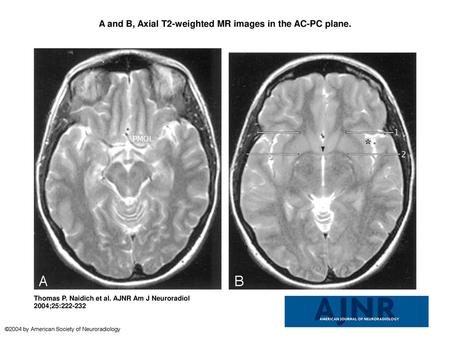A and B, Axial T2-weighted MR images in the AC-PC plane.
