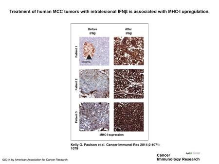 Treatment of human MCC tumors with intralesional IFNβ is associated with MHC-I upregulation. Treatment of human MCC tumors with intralesional IFNβ is associated.