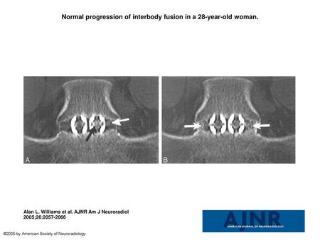 Normal progression of interbody fusion in a 28-year-old woman.