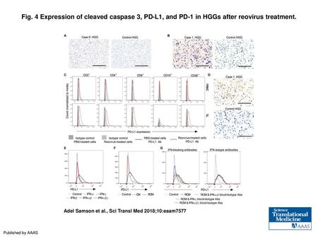 Fig. 4 Expression of cleaved caspase 3, PD-L1, and PD-1 in HGGs after reovirus treatment. Expression of cleaved caspase 3, PD-L1, and PD-1 in HGGs after.
