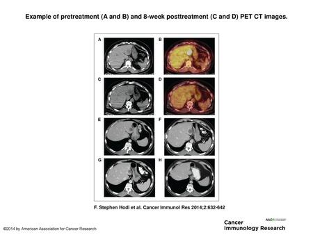 Example of pretreatment (A and B) and 8-week posttreatment (C and D) PET CT images. Example of pretreatment (A and B) and 8-week posttreatment (C and D)