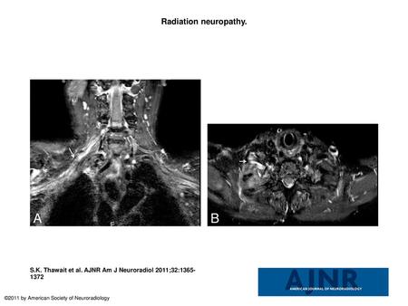 Radiation neuropathy. Radiation neuropathy. A 69-year-old woman with a history of breast carcinoma and external beam radiation therapy 2 years before imaging.