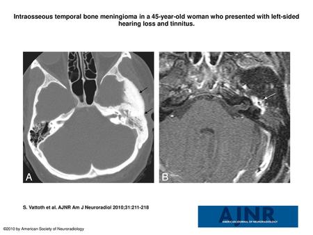 Intraosseous temporal bone meningioma in a 45-year-old woman who presented with left-sided hearing loss and tinnitus. Intraosseous temporal bone meningioma.