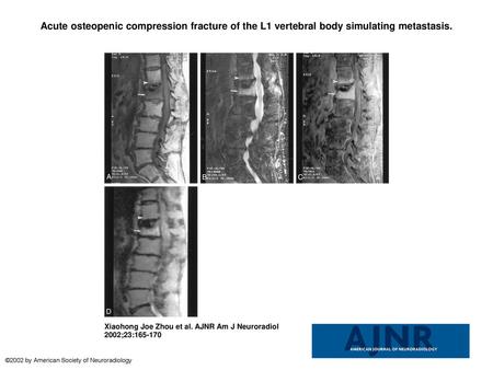 Acute osteopenic compression fracture of the L1 vertebral body simulating metastasis. Acute osteopenic compression fracture of the L1 vertebral body simulating.