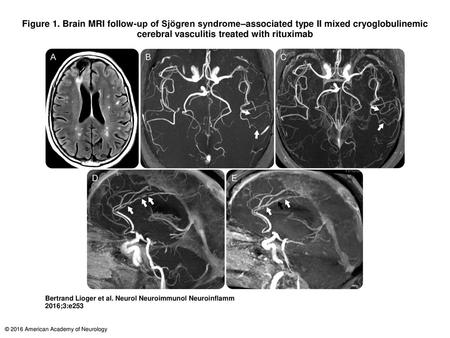 Figure 1. Brain MRI follow-up of Sjögren syndrome–associated type II mixed cryoglobulinemic cerebral vasculitis treated with rituximab Brain MRI follow-up.