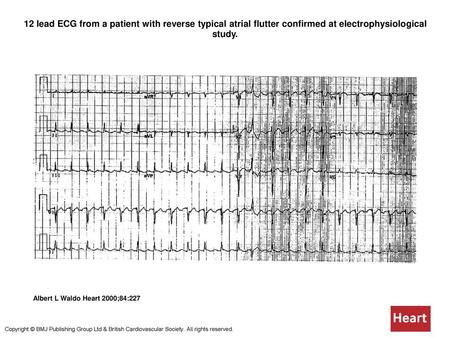 12 lead ECG from a patient with reverse typical atrial flutter confirmed at electrophysiological study. 12 lead ECG from a patient with reverse typical.