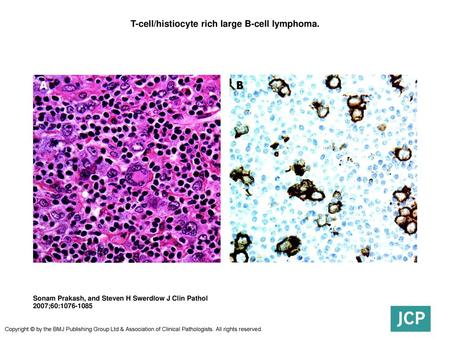 T-cell/histiocyte rich large B-cell lymphoma.