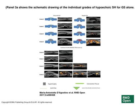 (Panel 3a shows the schematic drawing of the individual grades of hypoechoic SH for GS alone. (Panel 3a shows the schematic drawing of the individual grades.