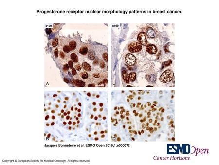 Progesterone receptor nuclear morphology patterns in breast cancer.