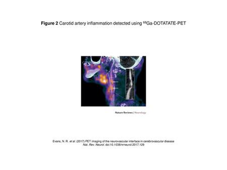 Figure 2 Carotid artery inflammation detected using 68Ga-DOTATATE-PET