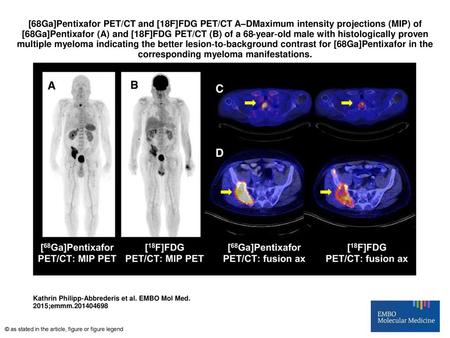 [68Ga]Pentixafor PET/CT and [18F]FDG PET/CT A–DMaximum intensity projections (MIP) of [68Ga]Pentixafor (A) and [18F]FDG PET/CT (B) of a 68‐year‐old male.