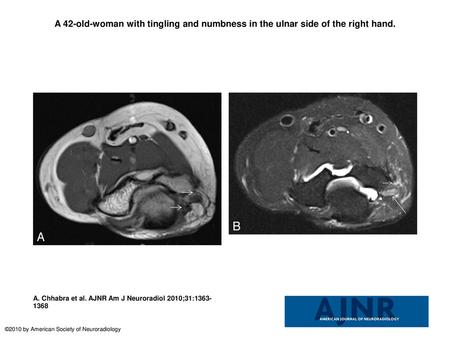 A 42-old-woman with tingling and numbness in the ulnar side of the right hand. A 42-old-woman with tingling and numbness in the ulnar side of the right.