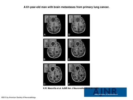 A 61-year-old man with brain metastases from primary lung cancer.