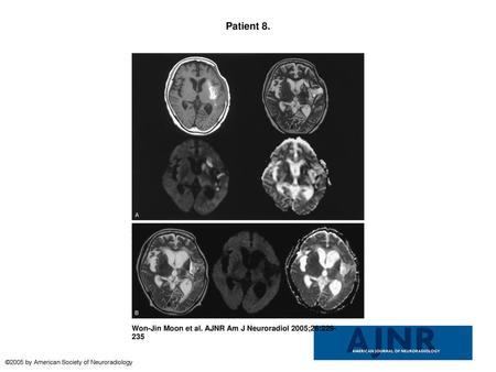 Patient 8. Patient 8. A 66-year-old man with late subacute intracerebral hematoma on MR images obtained 30 days after symptom onset.A, T1-weighted image.