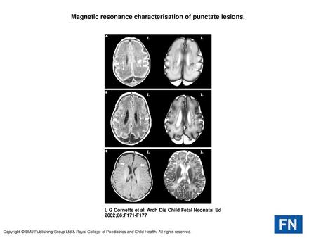 Magnetic resonance characterisation of punctate lesions.