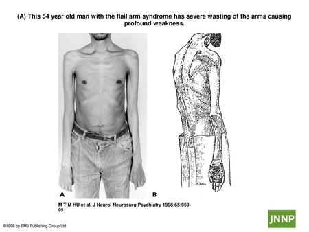 (A) This 54 year old man with the flail arm syndrome has severe wasting of the arms causing profound weakness. (A) This 54 year old man with the flail.