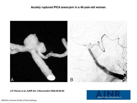Acutely ruptured PICA aneurysm in a 46-year-old woman.