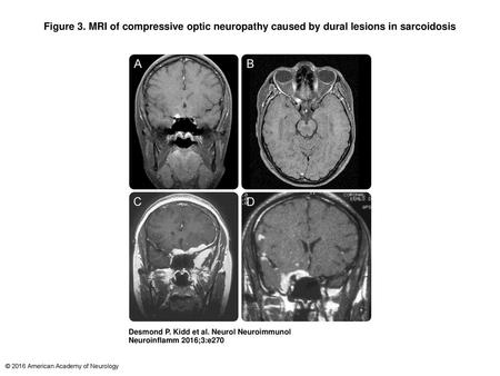 Figure 3. MRI of compressive optic neuropathy caused by dural lesions in sarcoidosis MRI of compressive optic neuropathy caused by dural lesions in sarcoidosis.