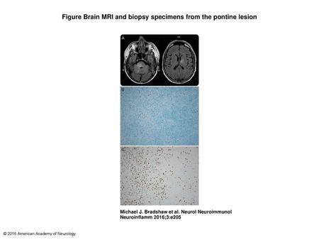 Figure Brain MRI and biopsy specimens from the pontine lesion