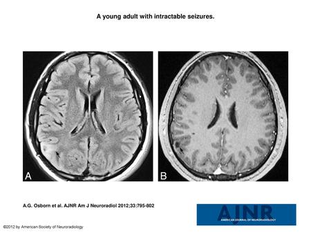 A young adult with intractable seizures.