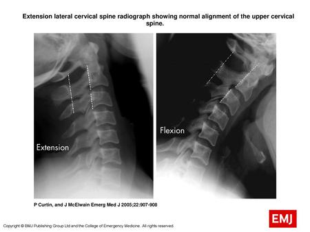  Extension lateral cervical spine radiograph showing normal alignment of the upper cervical spine.  Extension lateral cervical spine radiograph showing.