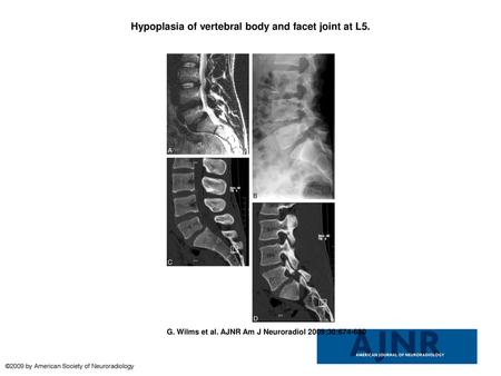 Hypoplasia of vertebral body and facet joint at L5.